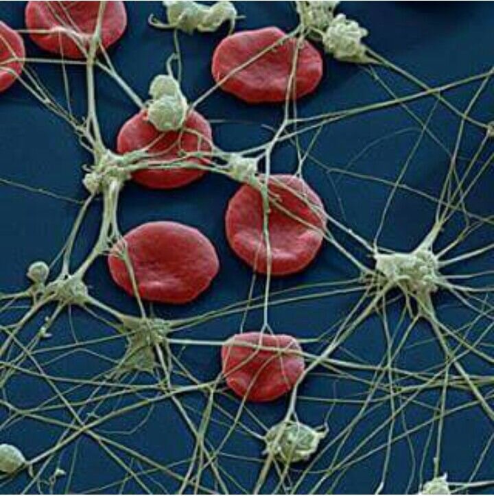 Так выглядит тромб под микроскопом. Тромбоциты и фибриновые нити, похожие на паутину
