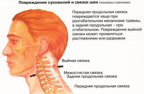 Перенапряжение мышц в шее болит