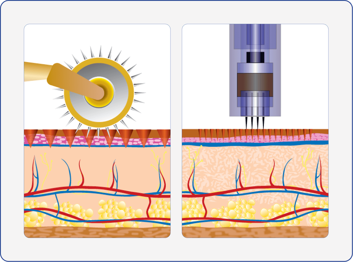 мезороллер и дермапен. аппарат для фракционной мезотерапии. дермапен или мезороллер что лучше. дермапен аппарат для мезотерапии a10 в использовании. дермапен конасова.