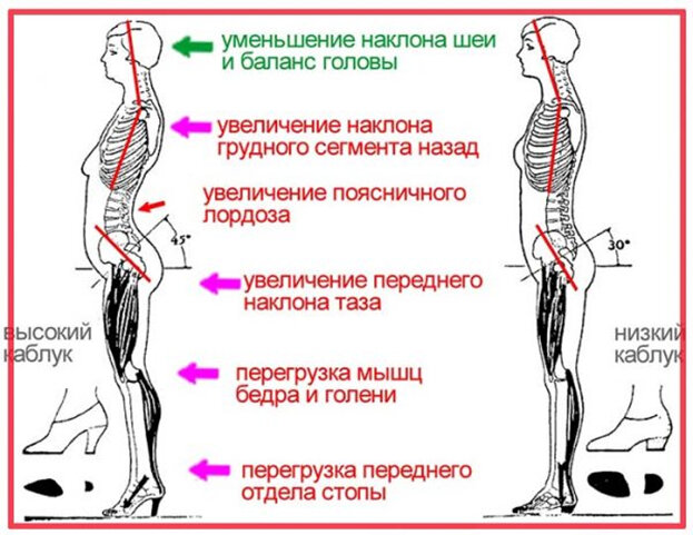 Спина после компрессионного перелома