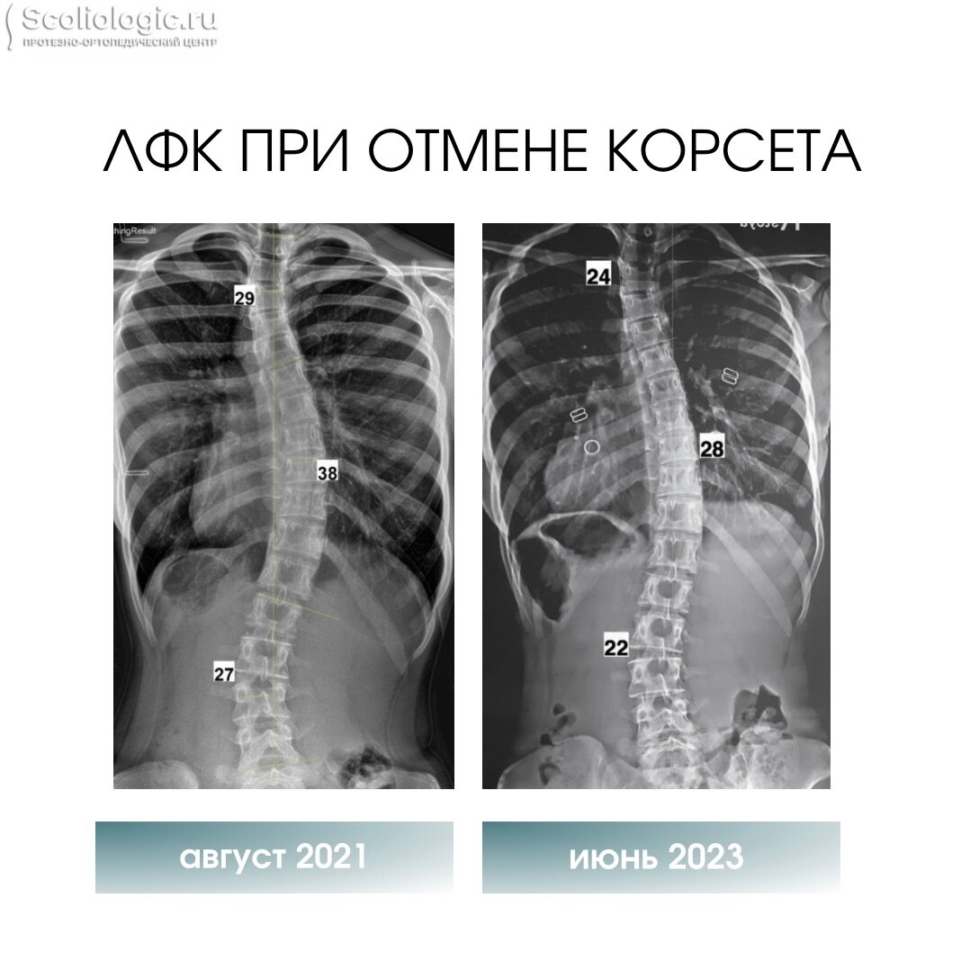 ЛФК в конце лечения сколиоза | Протезно-ортопедический центр | Дзен