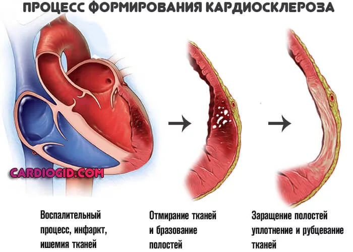 Кардиосклероз - виды, причины, симптомы, признаки, диагностика, лечение