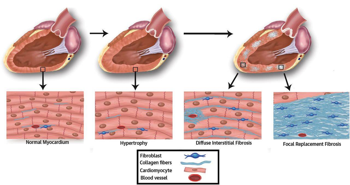 Фиброз это простыми словами у женщин. Постинфарктный кардиосклероз патогенез. Диффузный атеросклеротический кардиосклероз. ЭКГ ИБС постинфарктный кардиосклероз. Диффузный мелкоочаговый кардиосклероз.