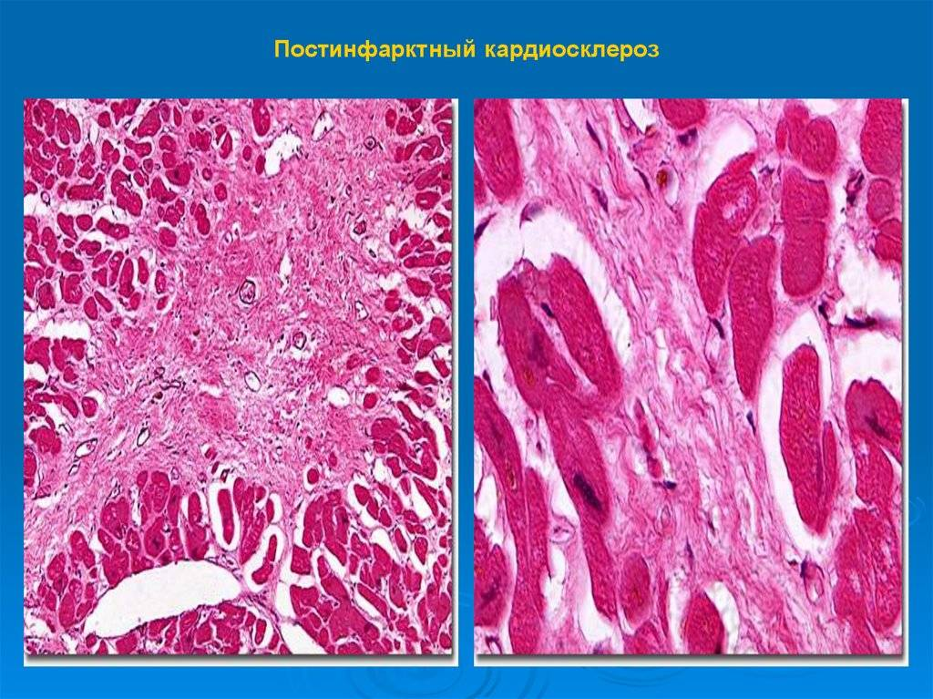 Кардиосклероз это. Постинфарктный крупноочаговый кардиосклероз патанатомия. Постинфарктный кардиосклероз окраска гематоксилином и эозином. Кардиосклероз макропрепарат. Атеросклеротический кардиосклероз макропрепарат