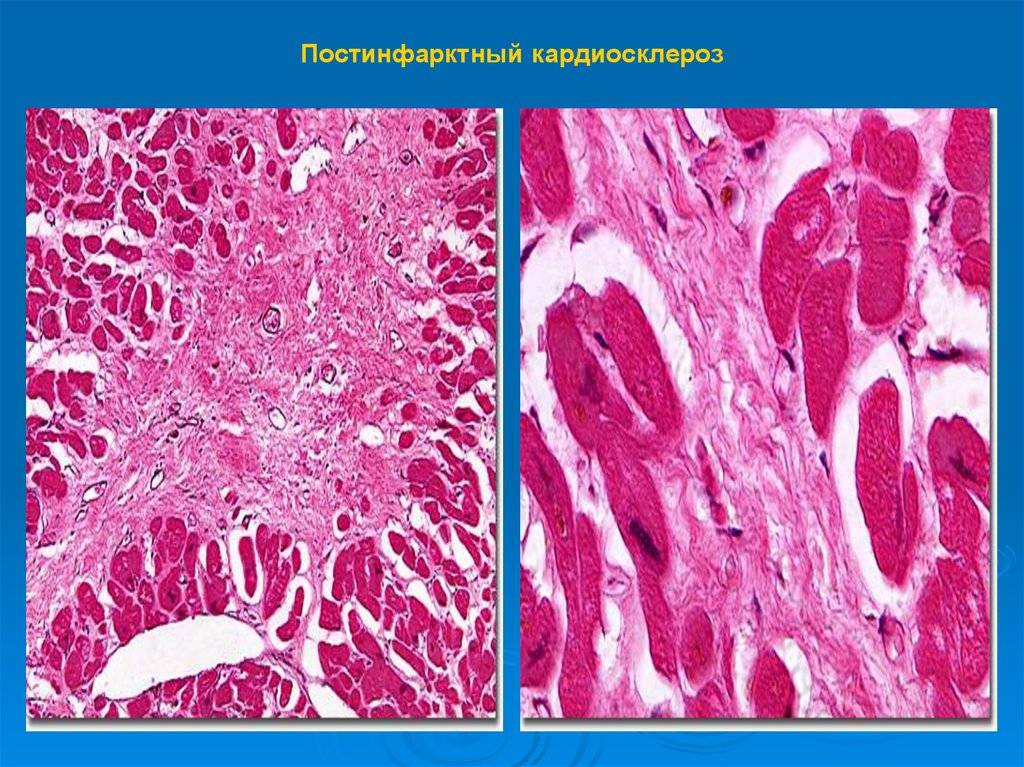 Кардиосклероз это. Постинфарктный крупноочаговый кардиосклероз патанатомия. Постинфарктный кардиосклероз окраска гематоксилином и эозином. Кардиосклероз макропрепарат. Атеросклеротический кардиосклероз макропрепарат.