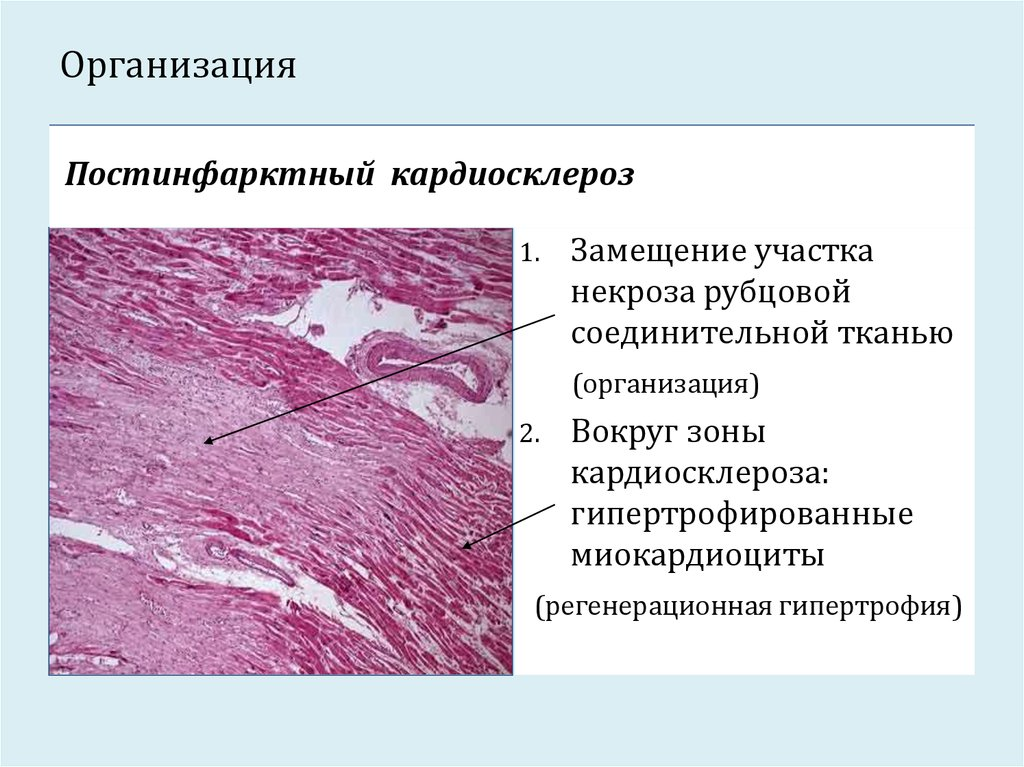 Образование рубцовой ткани