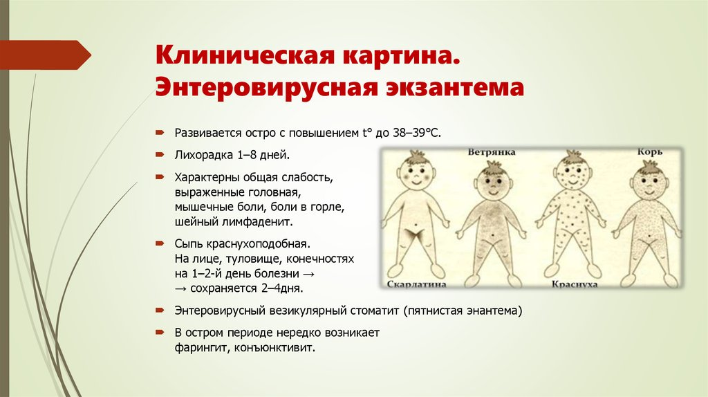 Ходит инфекция. Энтеровирусная сыпь симптомы. Энтеровирус на инфекция с сыпью. Энтеровирусная инфекция описание сыпи. Сыпь у детей при энтеровирусной