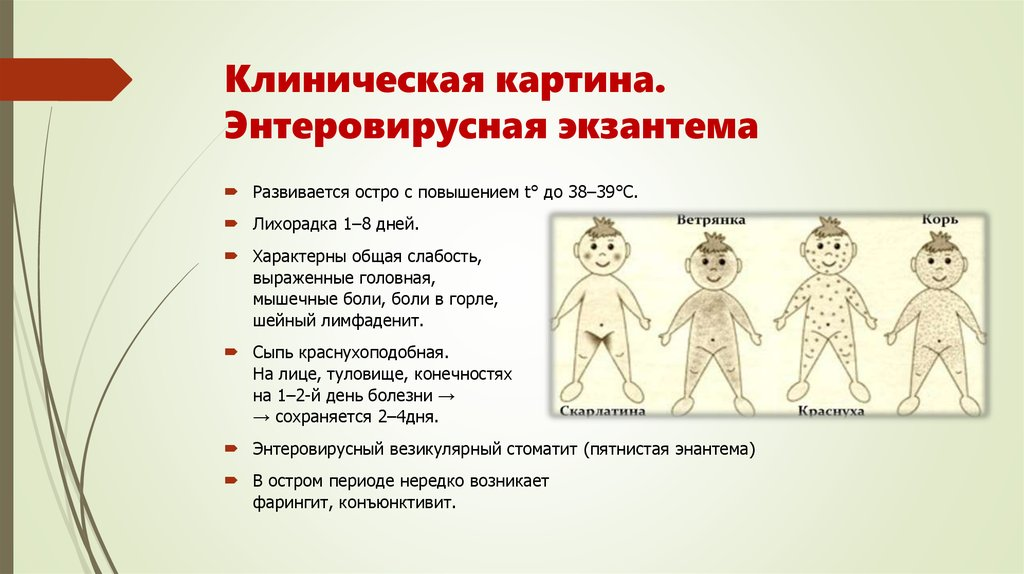 Инфекционные заболевания у детей с сыпью. Энтеровирусная сыпь симптомы. Энтеровирус на инфекция с сыпью. Энтеровирусная инфекция описание сыпи. Сыпь у детей при энтеровирусной.