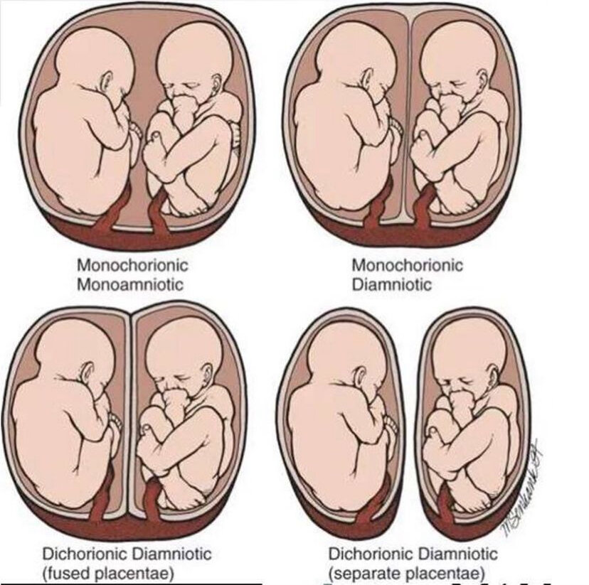 Бихориальная биамниотическая двойня что это простыми …