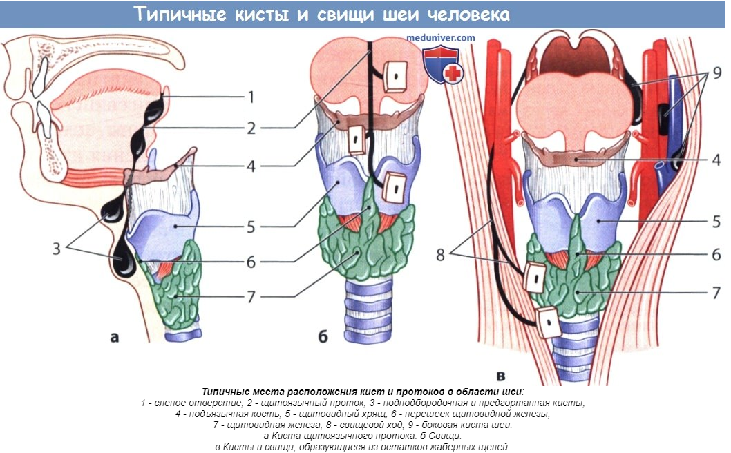 Средняя киста