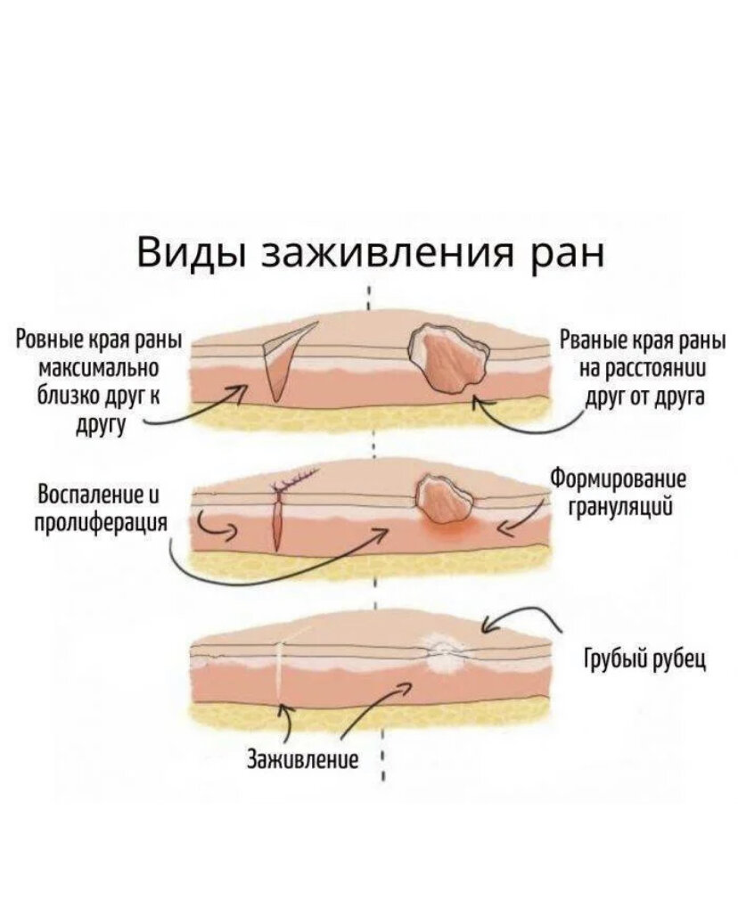 Этапы заживления. Процесс заживления РАН. Первичное заживление РАН. Заживление первичным натяжением. Заживление РАН первичным натяжением.