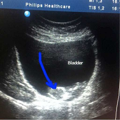 Неразвивающийся плод в мочевом пузыре