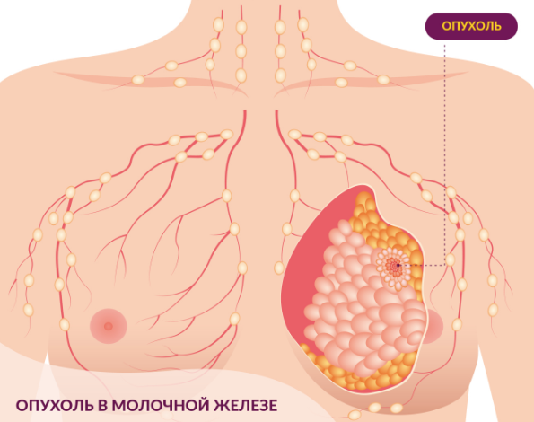 Уплотнения, узлы в молочной железе – диагностика причин, лечение в клинике в Москве