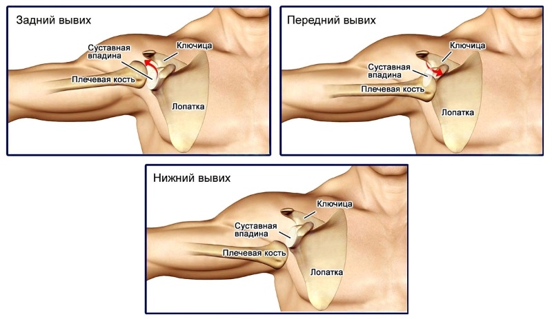 Передний вывих плеча