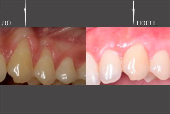 Оголение корней зубов и пластика рецессии десны