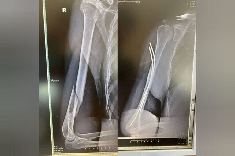    Оренбургские хирурги провели малоинвазивную операцию девочке с переломом плечевой кости Кристина Просвиркина