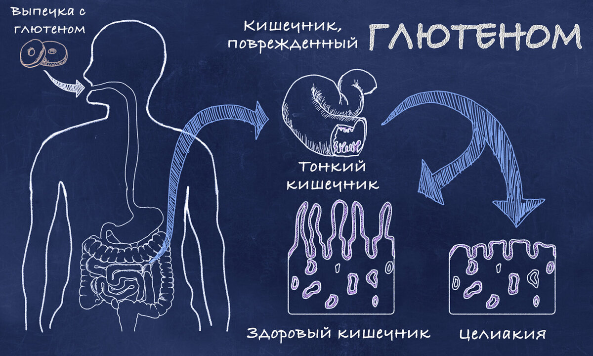 Целиакия | Med-cos.xyz | Дзен