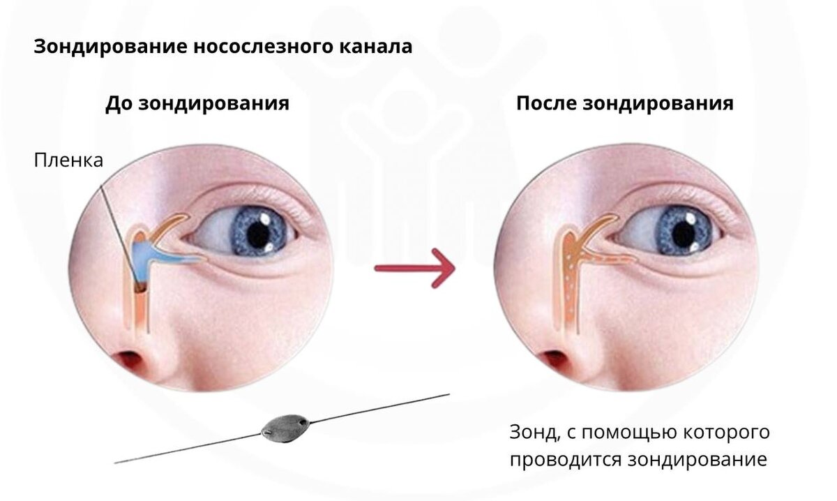 Массаж носослезного канала у грудничка