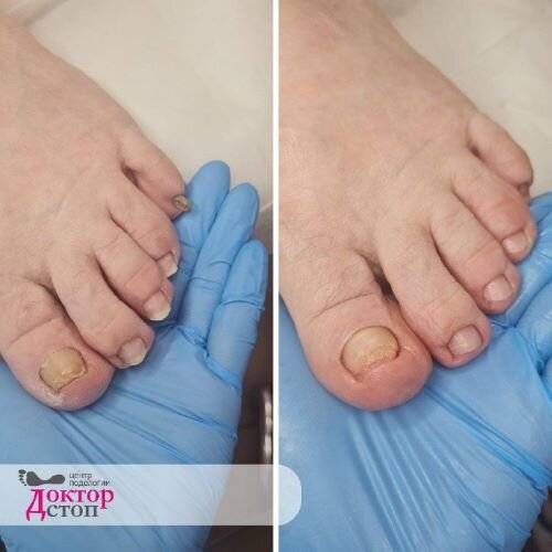 педикюр - до и после