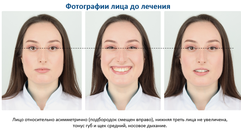 2.	Фотографии в профиль с сомкнутыми губами и с улыбкой позволяют оценить тип профиля и наклон верхних резцов.