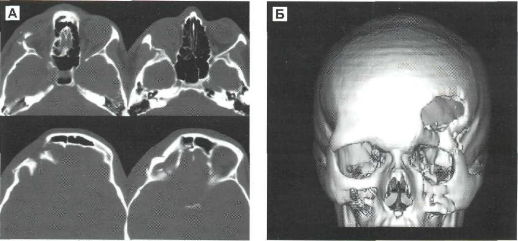 Вдавленный перелом передней стенки лобной пазухи