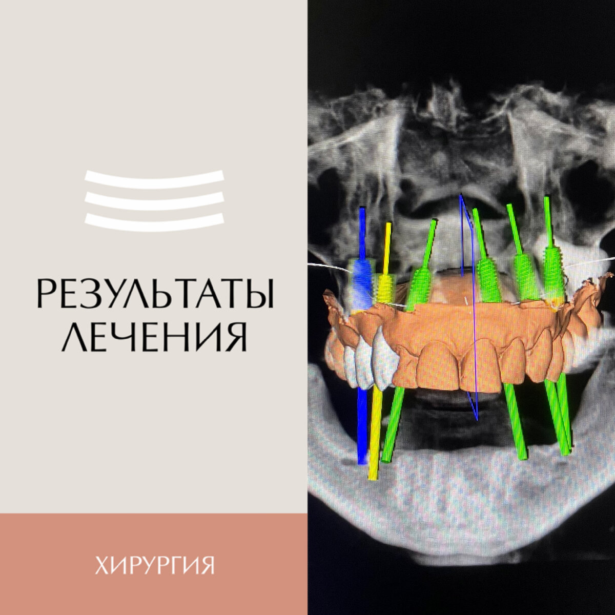 Тотальная имплантация зубов | Стоматология СТУДИЯ УЛЫБОК г. Сочи | Дзен