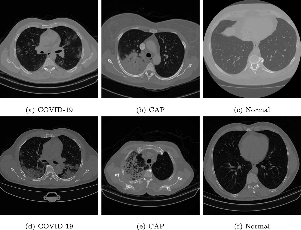 Covid-19 — ассоциированная с коронавирусом пневмония; community-acquired pneumonia (CAP) — внебольничная пневмония, которой человек заразился вне системы здравоохранения в отличие от внутрибольничной пневмонии; normal — здоровые лёгкие. Источник фото: https://doi.org/10.1016/j.bspc.2023.105285