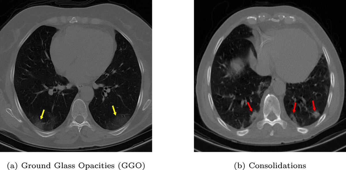 GGO — помутнения по типу «матового стекла»; consolidation — лёгочная консолидация. Источник фото: https://doi.org/10.1016/j.bspc.2023.105285