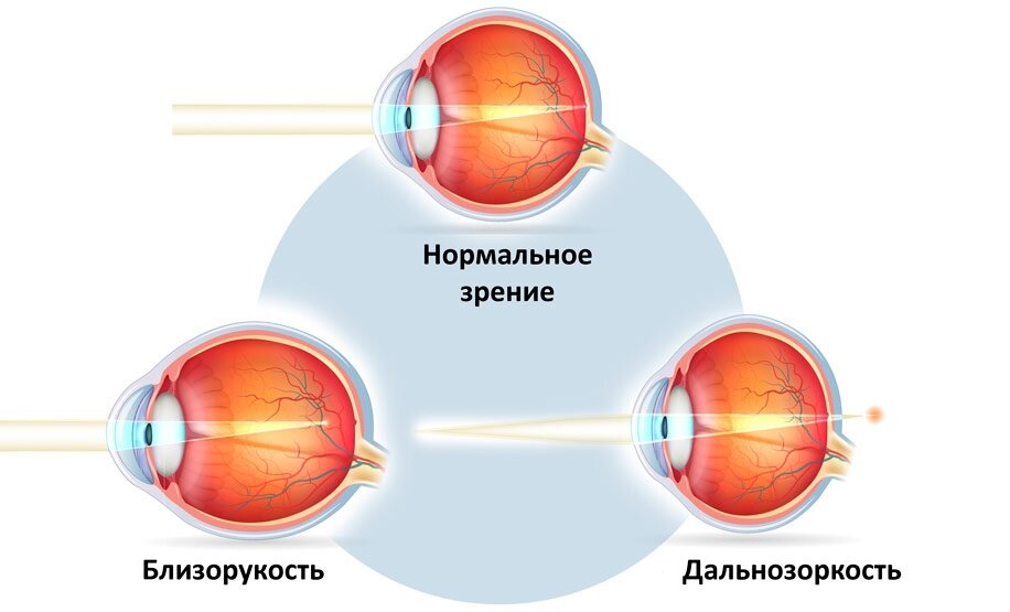 Лечение дальнозоркости методом лазерной коррекции в Красноярске