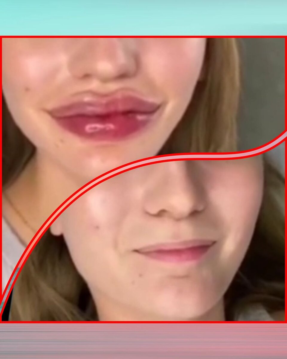 До и после. Губы и ничего больше