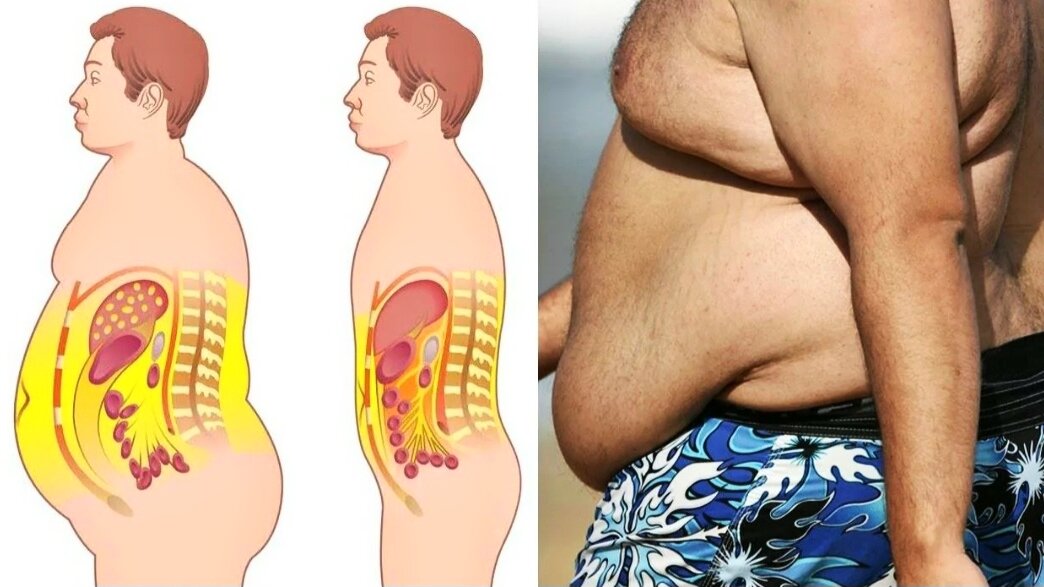 Мужчины больше подвержены абдоминальному ожирению