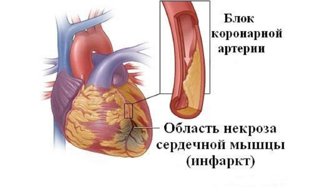 Можно ли пережить инфаркт и даже этого не заметить?