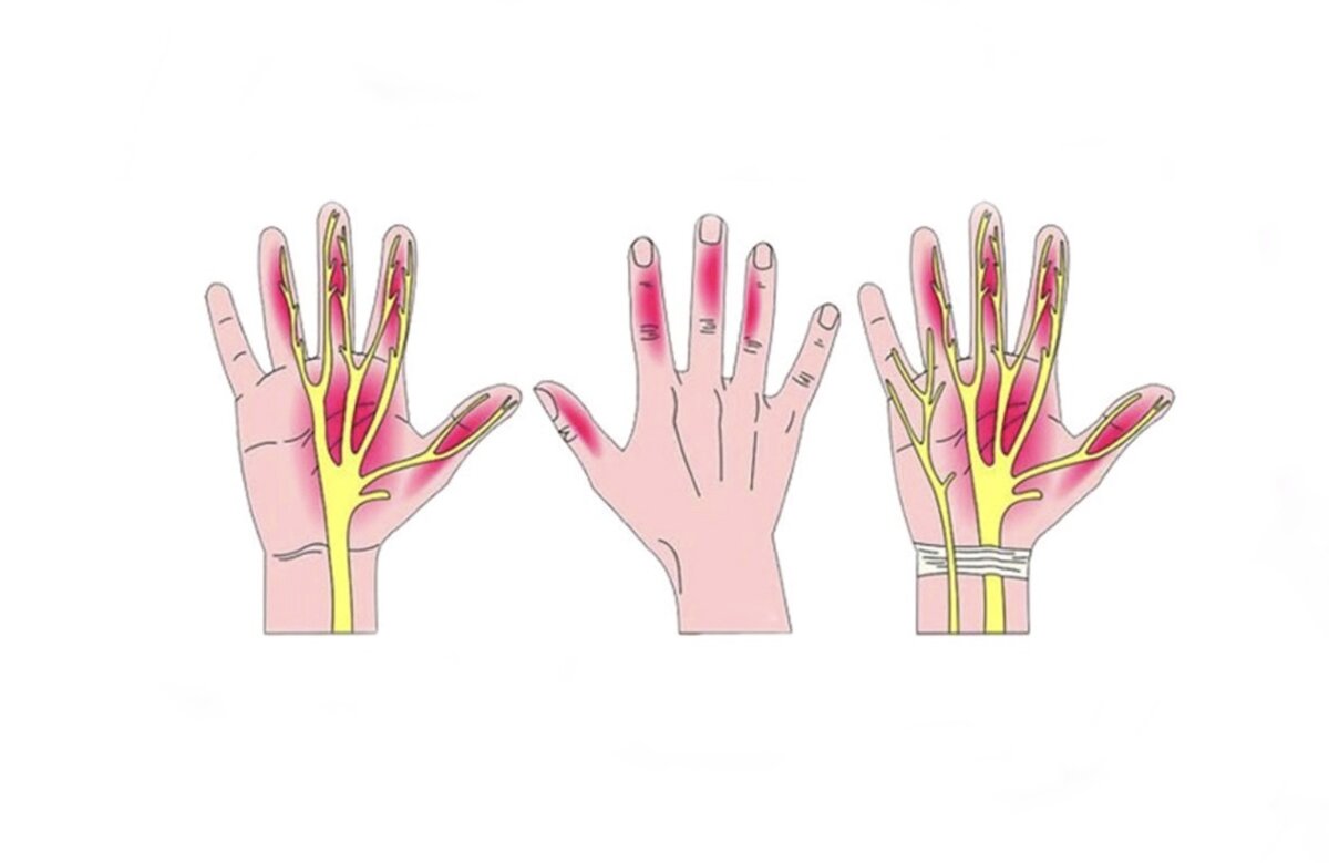 Боль и онемение в области кисти являются признаками туннельного ...