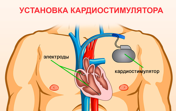 Постановка экс. Установка кардиостимулятора. Установленный кардиостимулятор. Имплантация электрокардиостимулятора.