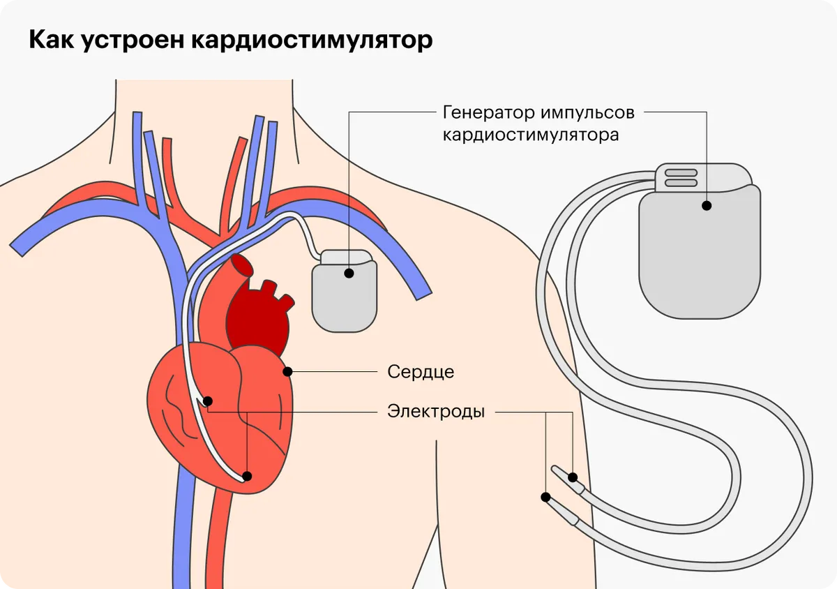 Зачем нужен кардиостимулятор при аритмии: замедление сердечного ритма и его  коррекция | О здоровье: с медицинского на русский | Дзен