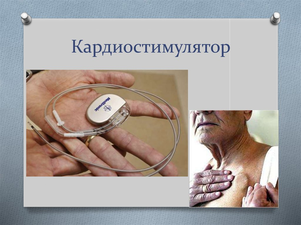Preventing Heart Diseases with Implantable Cardiac Pacemakers