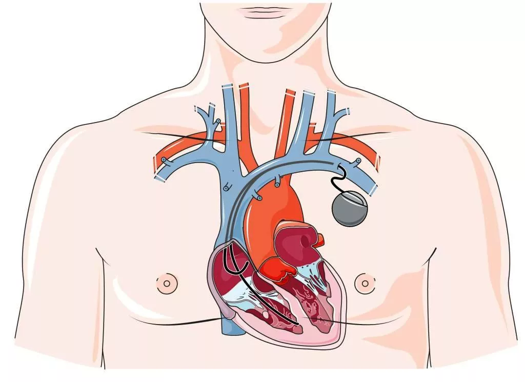 Что такое кардиостимулятор, для чего он необходим и как меняется жизнь после его установки