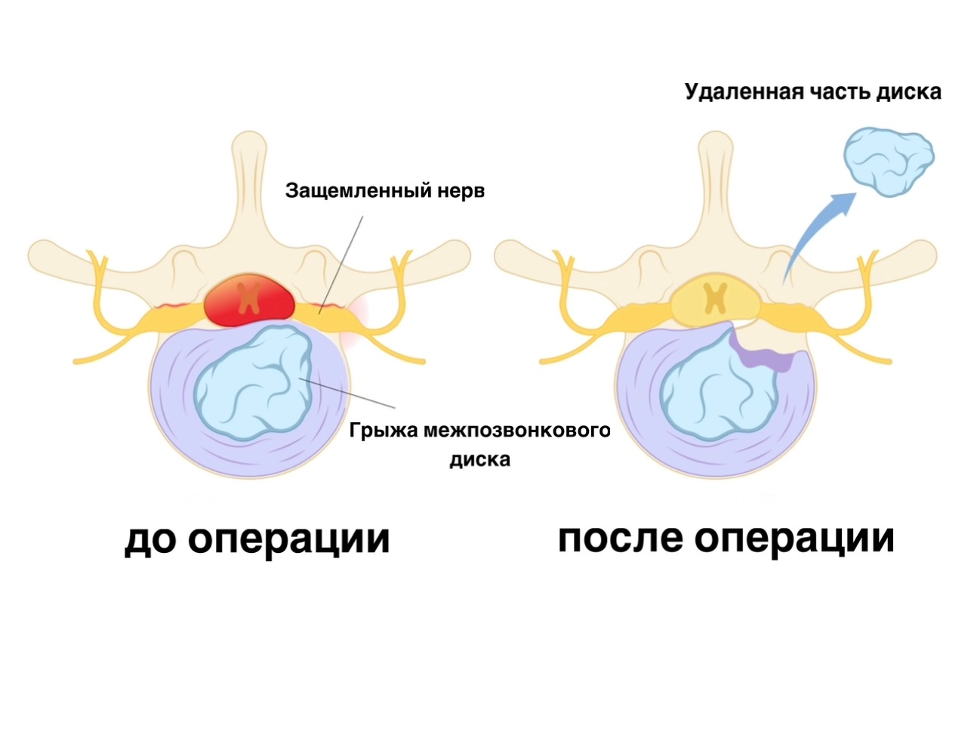 Микрохирургическое удаление грыжи позвоночника (микродискэктомия)