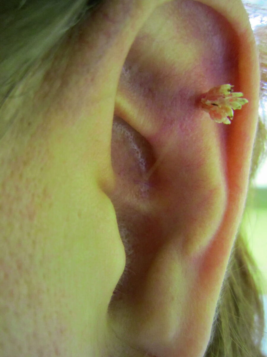 Нитевидная бородавка