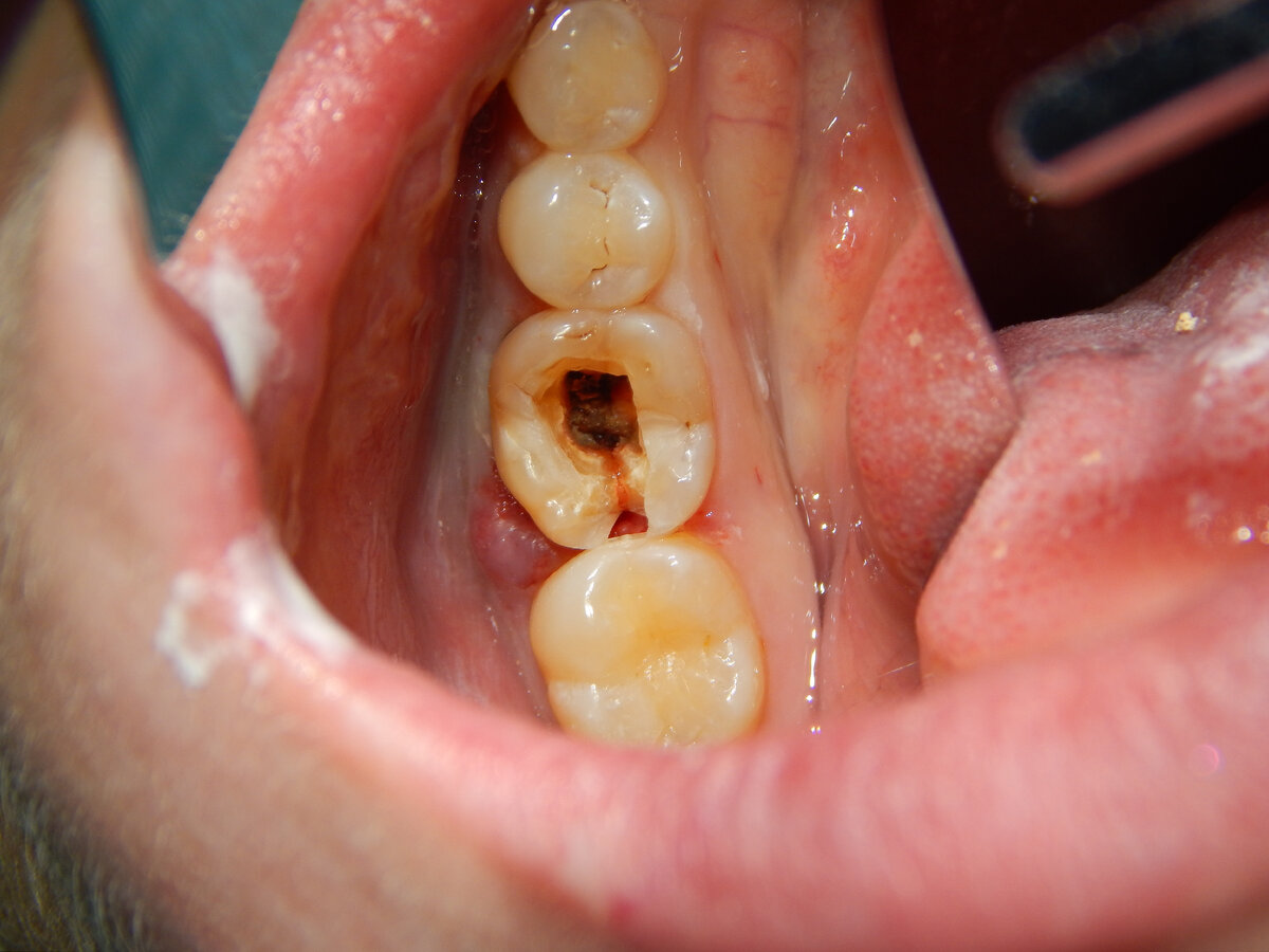 Зуб треснул пополам, можно ли его спасти – статьи стоматологической клиники «Доктор Мартин»