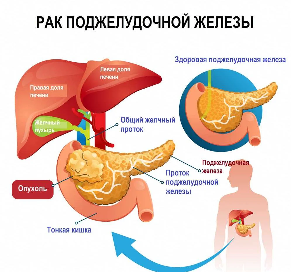 Желчный пузырь и поджелудочная железа анализы. Опухоль поджелудочной железы. Онкология поджелудочной. Онкология поджелудочной железы. Карцинома поджелудочной железы.