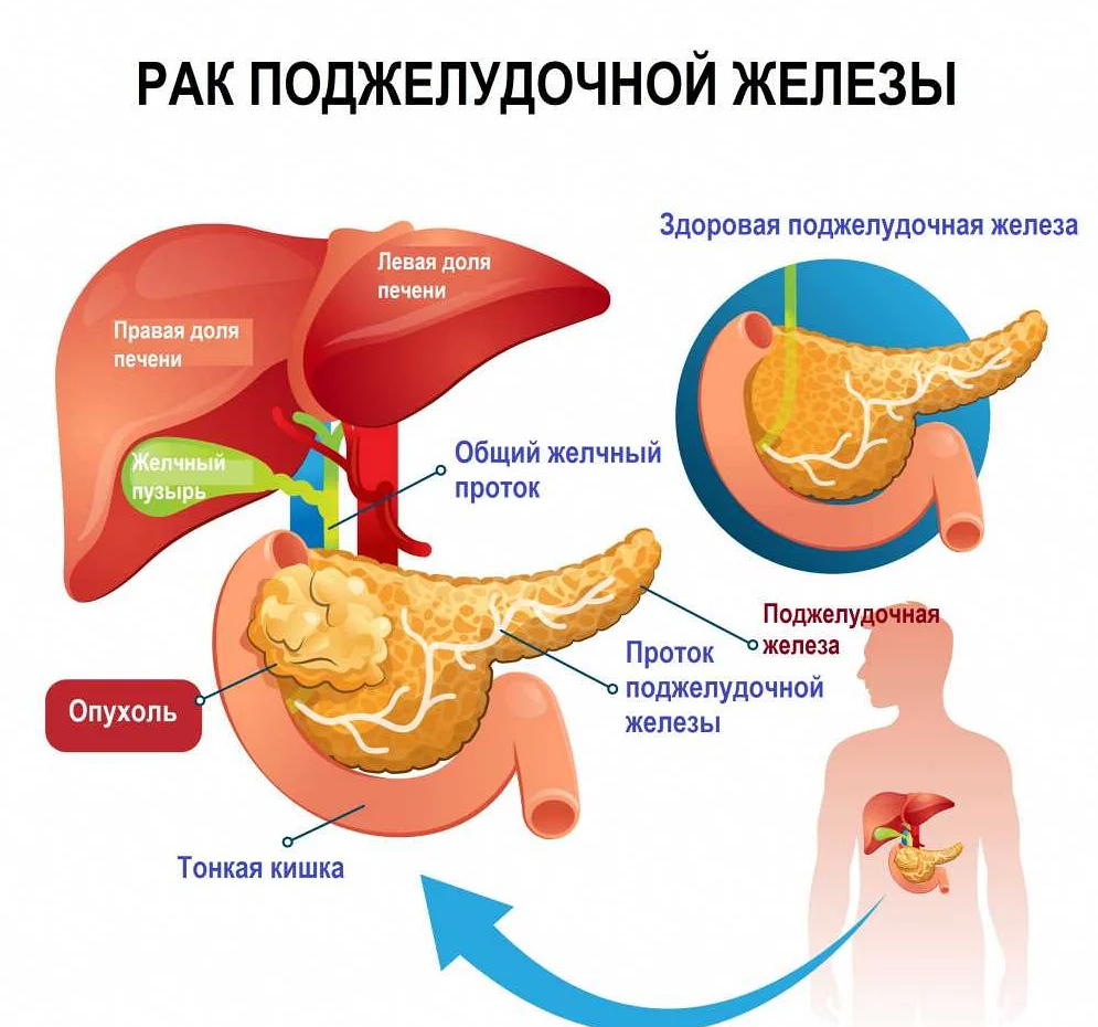 Поджелудочная железа где находится как лечить. Липаза поджелудочной железы. Липоз поджелудочной железы. Симптомы поражения поджелудочной железы. Опухоли поджелудочной железы патогенез.