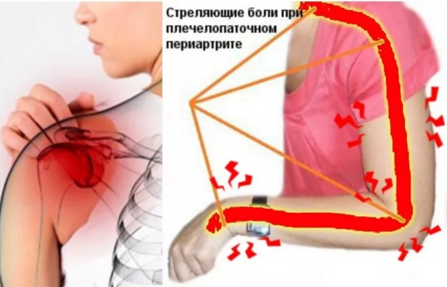 Плечелопаточный периартрит. Плечелопаточный периартроз симптомы. Плечелопаточный периартрит симптомы. Плече периартрит плечелопаточный периартрит.