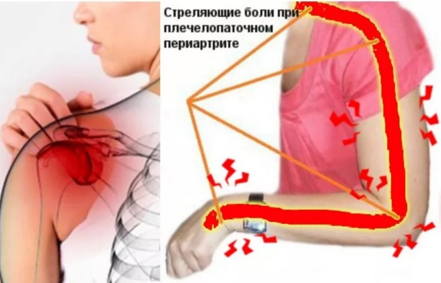 Как лечить плечевой. Плечелопаточный периартрит. Плечелопаточный периартроз симптомы. Плечелопаточный периартрит симптомы. Плече периартрит плечелопаточный периартрит.