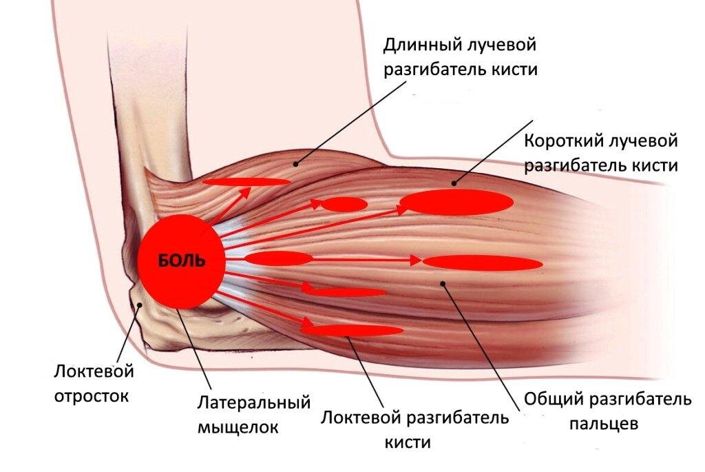 Латеральный эпикондилит локтевого. Мышцы и сухожилия локтевого сустава. Латеральный эпикондилит сухожилие. Надмыщелок локтевого сустава воспаление.