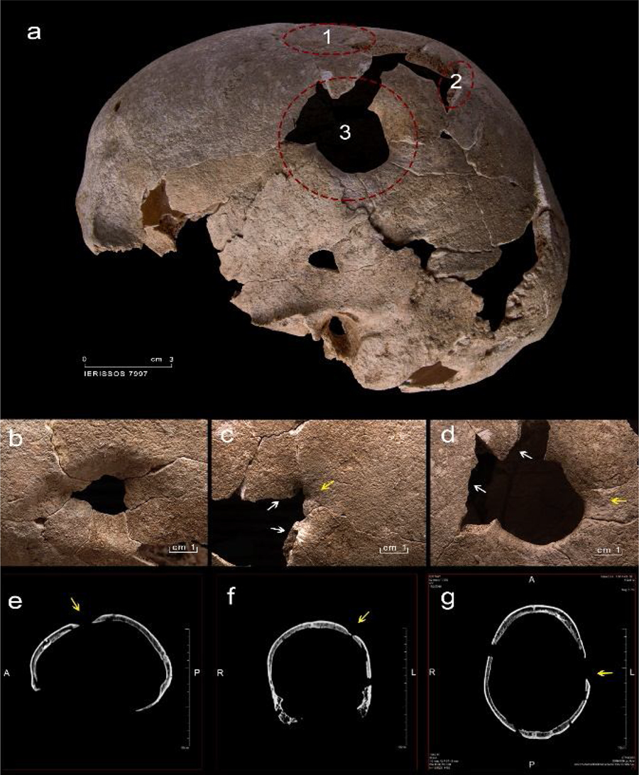Череп из погребения No 7997 из Аканфа.