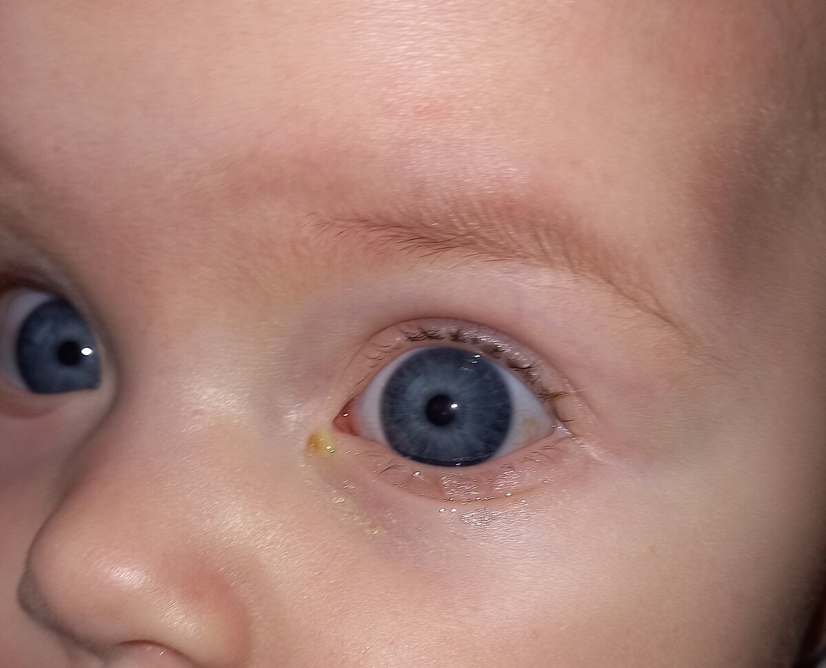 Фото автора. 2 недели после зондирования.