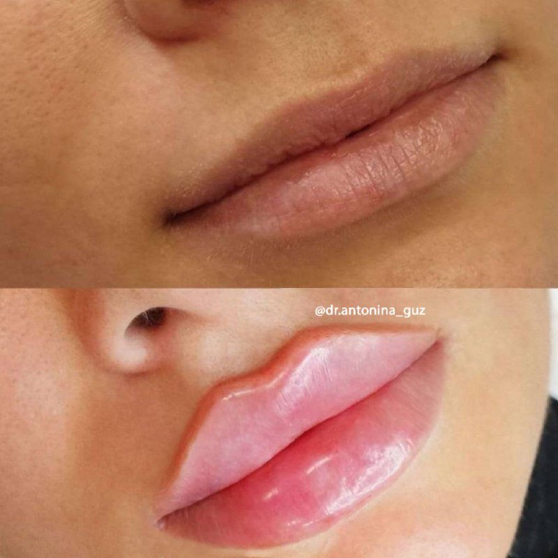 Техники увеличения губ. Что вообще можно сделать с губами?