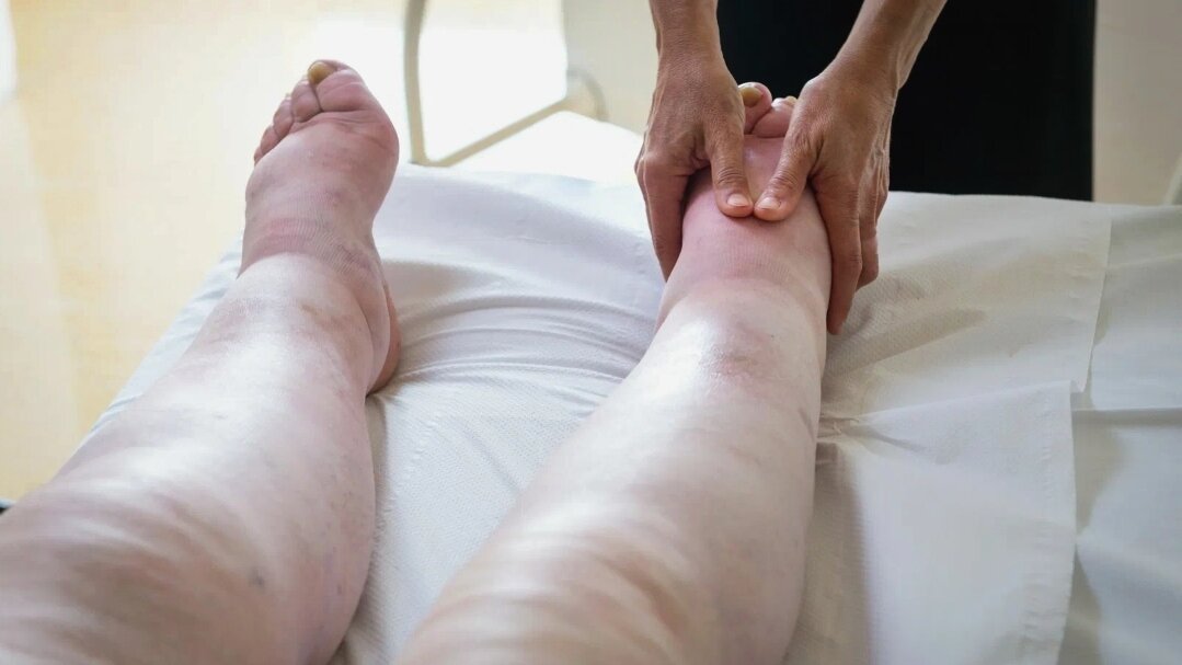 Нарушение лимфотока — это очень опасно. Лимфостаз — прогрессирующее заболевание, его нельзя пускать на самотёк 