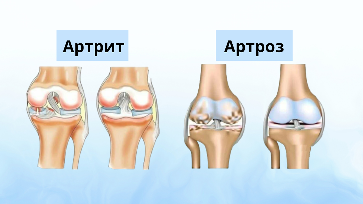 Артрит и артроз: что из них страшнее? Разбираемся в различиях болезней, как  выявить и предотвратить. | REHAB.YOU | Дзен